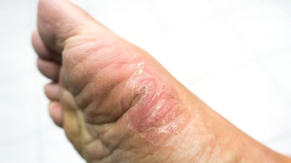 ¿Qué es el pie de atleta? Síntomas, causas y cómo tratar la enfermedad