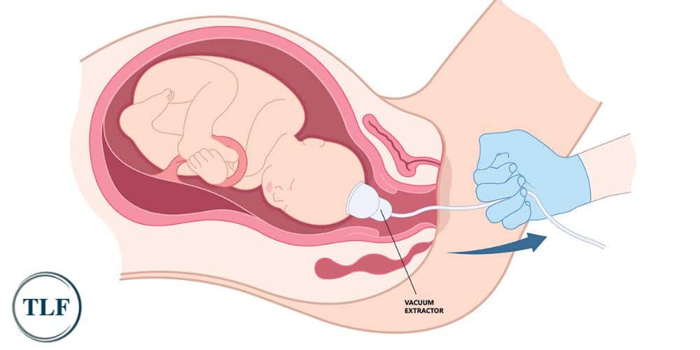 Northern Kentucky Lawyers for Vacuum Extraction Injuries
