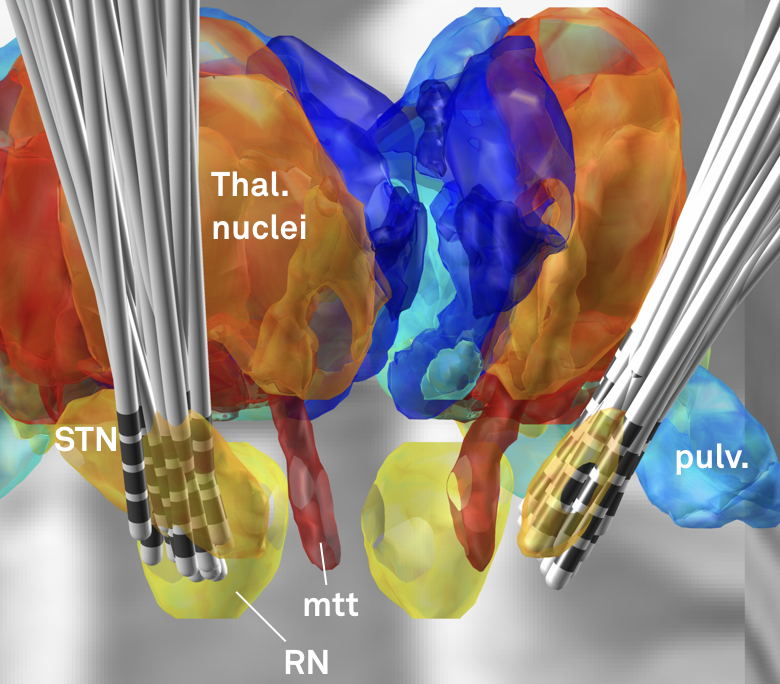 Subcortical Electrophysiology Mapping LeadDBS