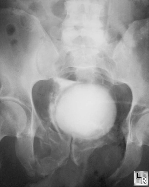 LearningRadiology Bladder Rupture, Intraperitoneal and Extraperitoneal