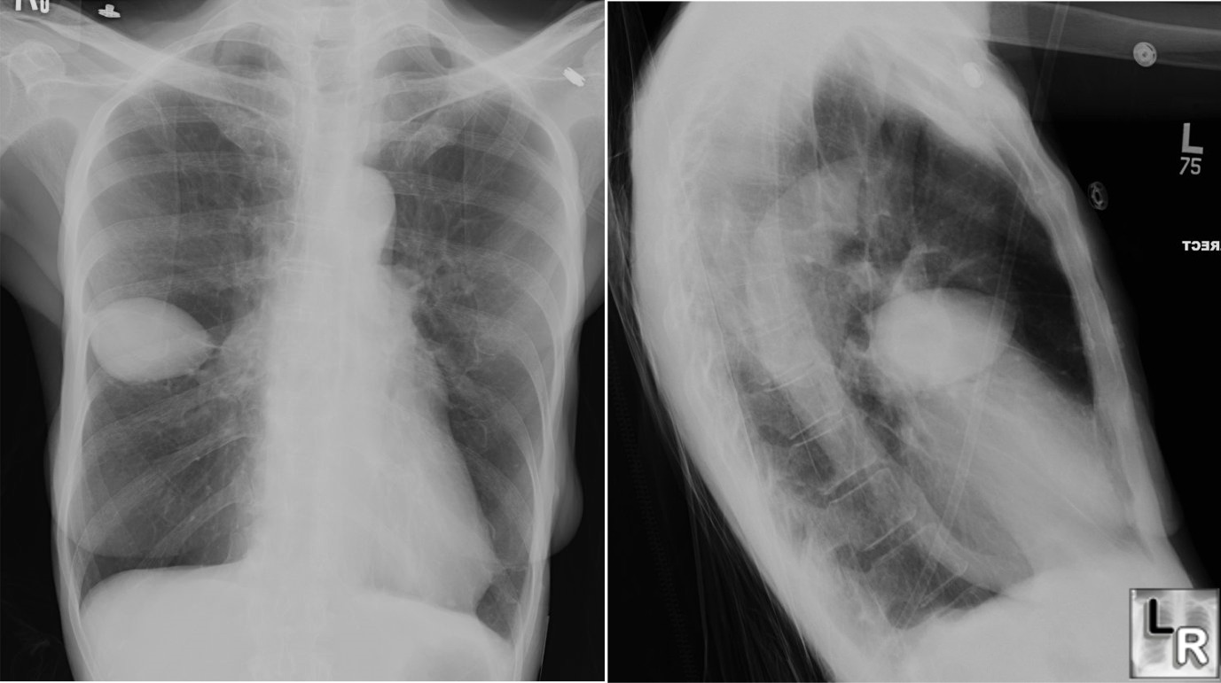 Pseudotumor, Vanishing Tumor, Effusion, Minor