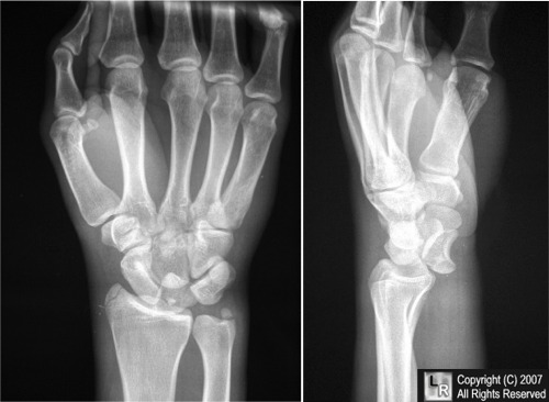 Learning Radiology Lunate, Dislocation, Perilunate