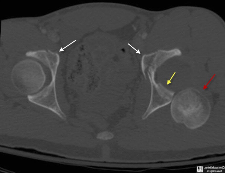 LearningRadiology posterior, hip, dislocation