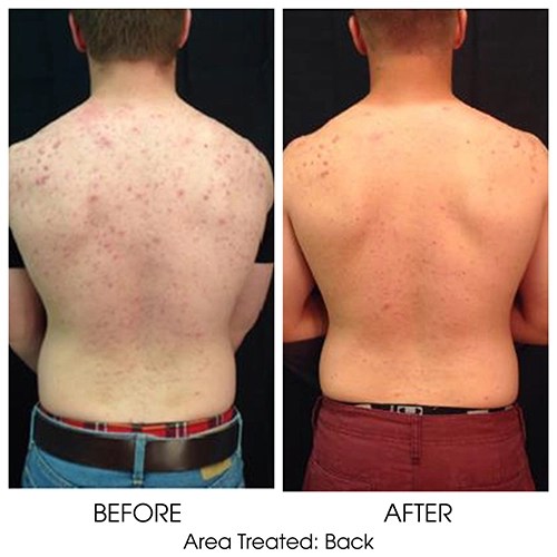 Chemical Peels Lébo Aesthetics & Spa York & Hanover PA