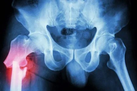 249,000 Compensation For A Broken Pelvis - Legal Expert