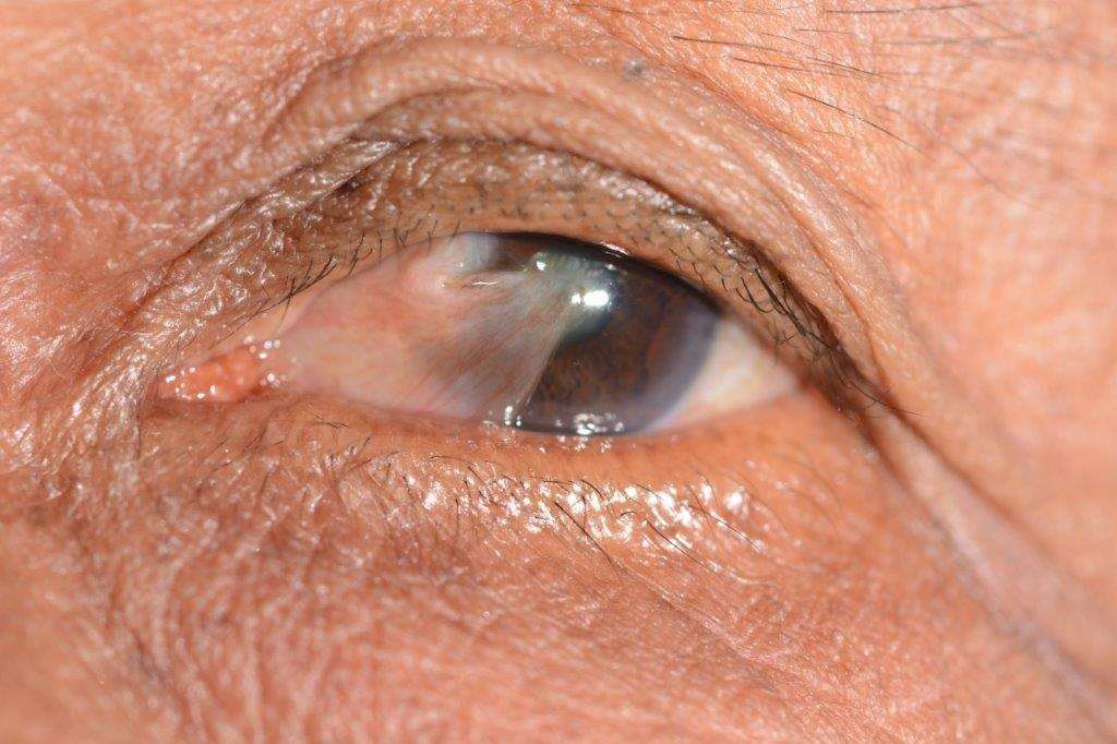 Pterygium (Surfers Eye) Symptoms, Causes & Treatment Lions Eye