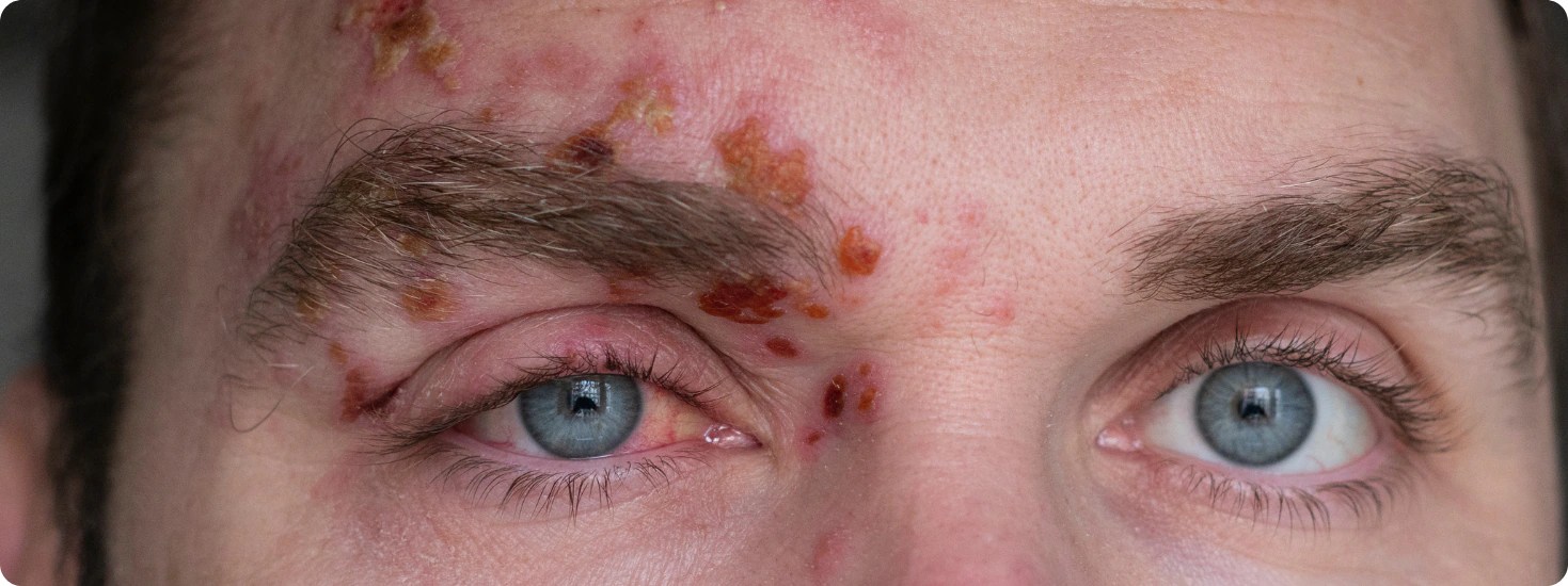 New Research Supports LongTerm, LowDose Antiviral Use for Shingles