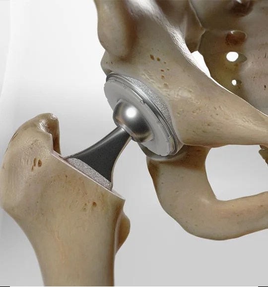 Robotic Hip Replacement Surgery for Total Hip Replacement