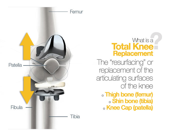 What is a Total Knee Replacement? A Simple Visual Explanation Naples