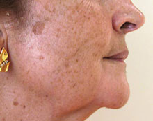 Aromatherapie Et Acne Conseils Cosmetiques Bio