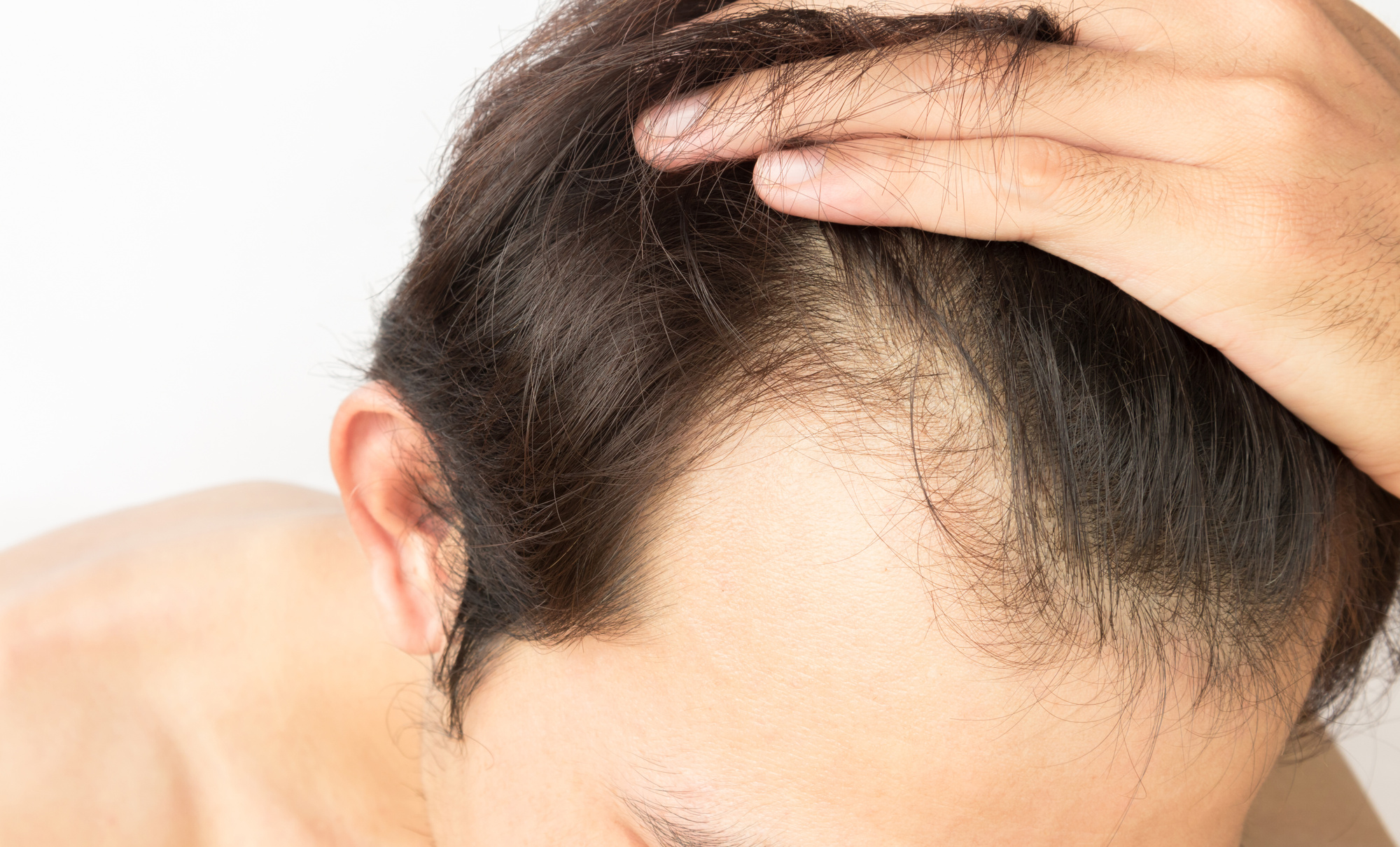 Bald Isn’t Always Beautiful 10 Ways to Regrow Hair Bald Isn’t Always Beautiful 10 Ways to Regrow Hair