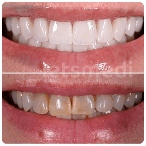 Porcelain Veneers in Turkey Letsmedi