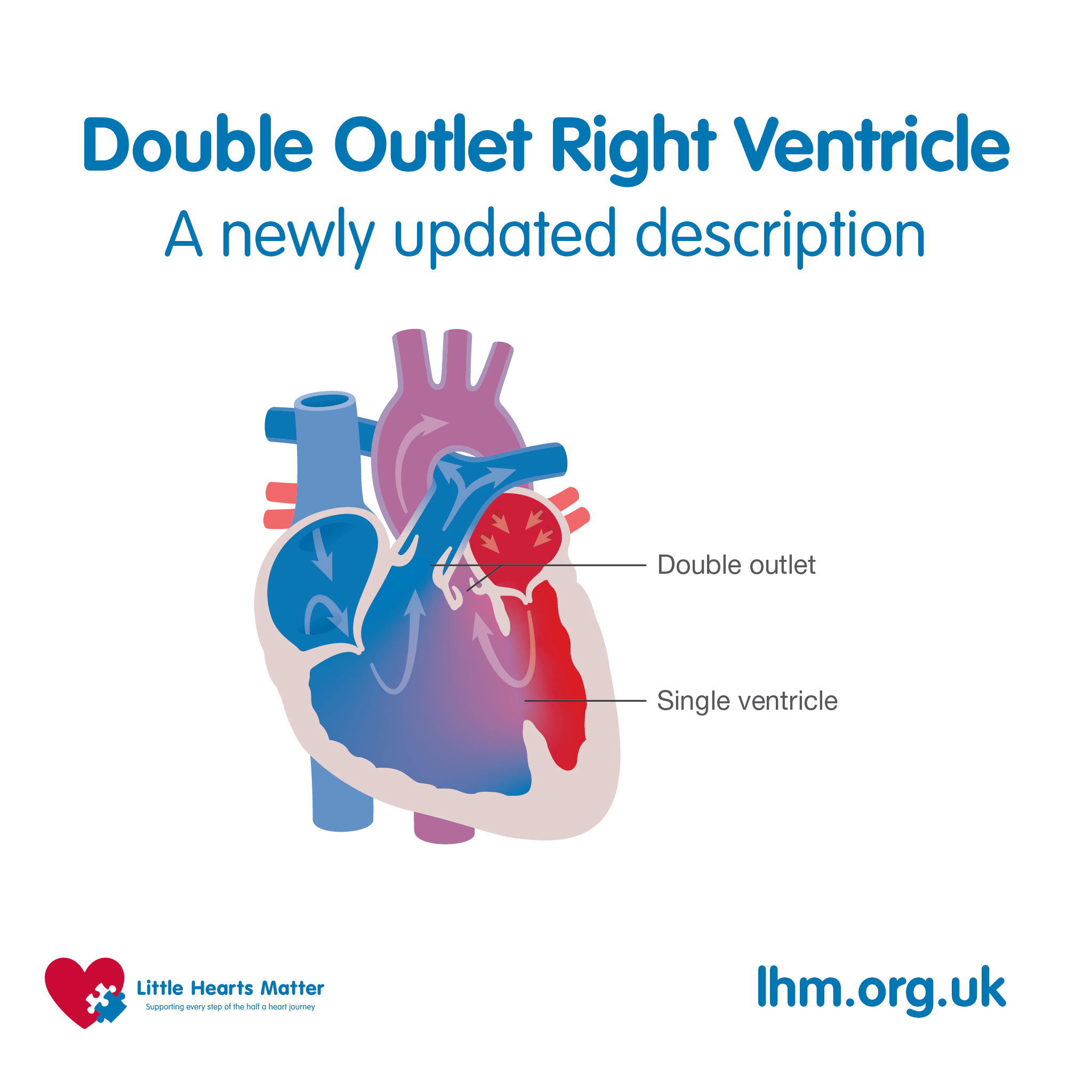 Double Outlet Right Ventricle Youth Zone Little Hearts Matter