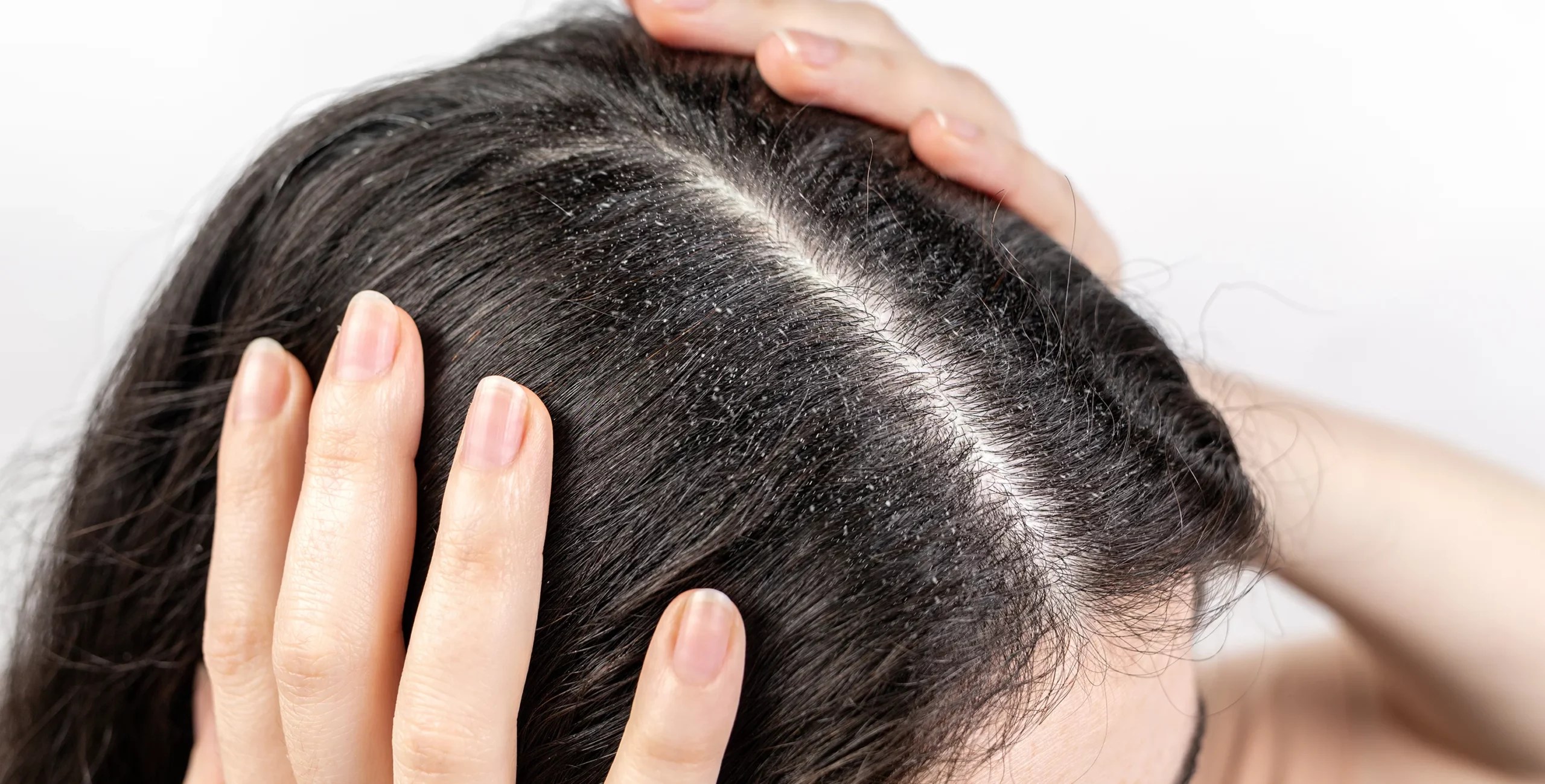 Lice vs. Dandruff, What’s the Difference?