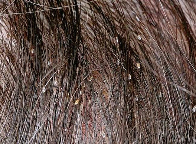 Picture Of Lice Nits In Hair