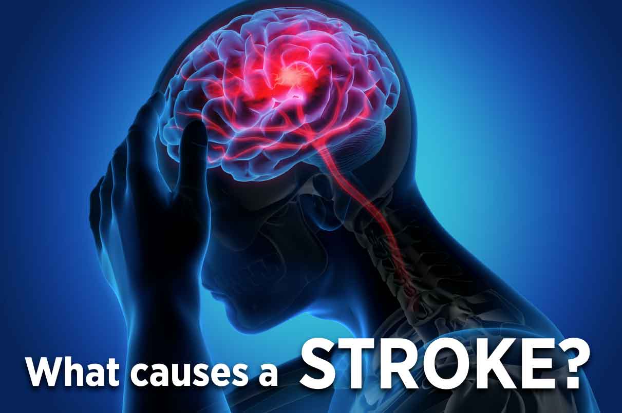 What causes a stroke? Life Line Screening