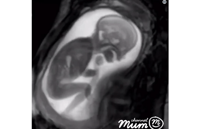 Best ProLife Video Ever? Astonishing MRI Scan Shows 20