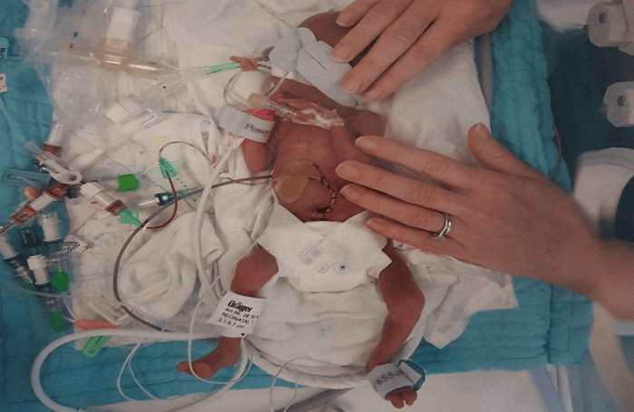 Premature Baby Born at 24 Weeks Weighed Less Than a Can of Beans, Look