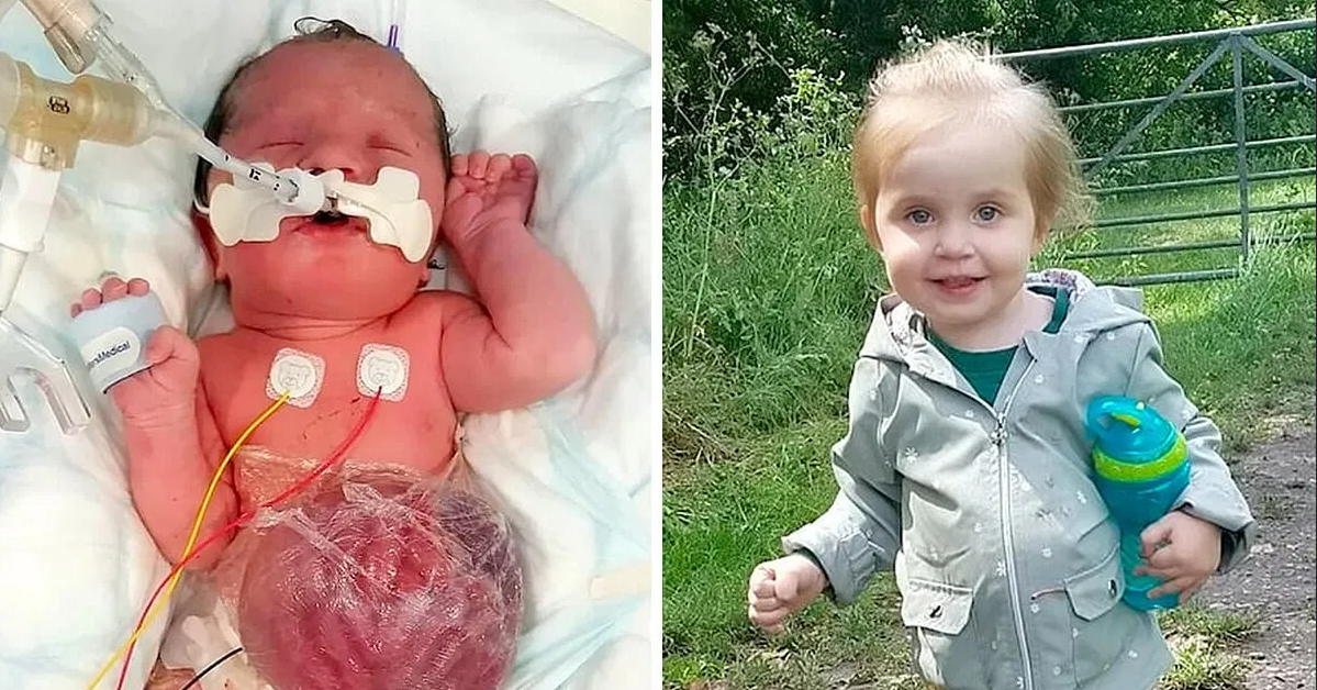 Girl Born With Her Vital Organs Outside Her Body Doing