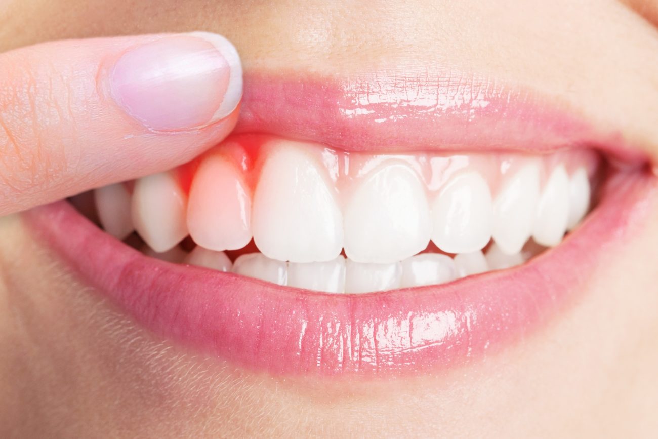 My Gums Are Bleeding Frequently, What Does It Mean