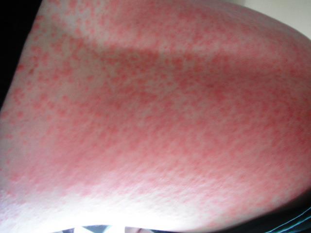 Allergic Reaction to Amoxicillin Rash, Hives, Oh My! Home Remedies