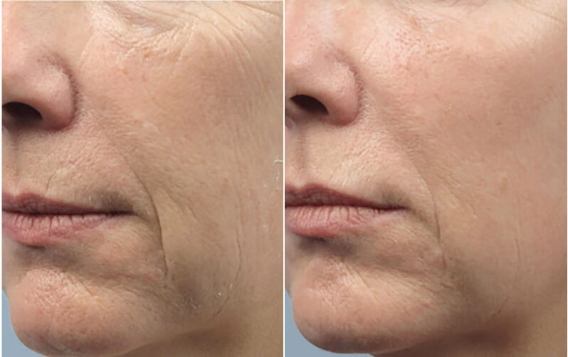 Skin Rejuvenation Before & After LightRx MedSpa