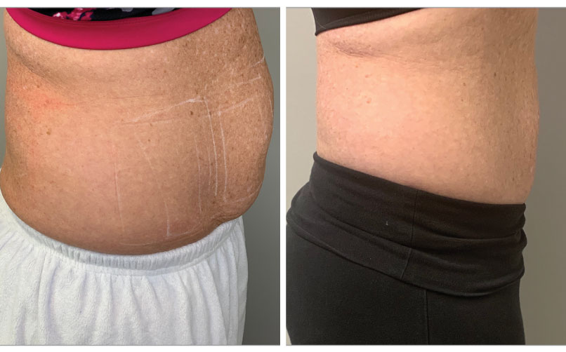 Venus Bliss Before & After LightRx MedSpa