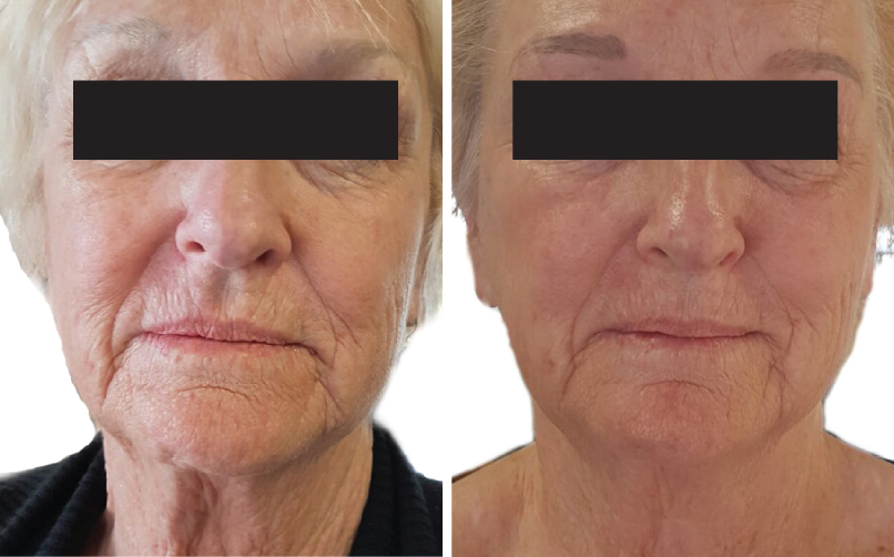 Face Skin Tightening Before & After LightRx MedSpa