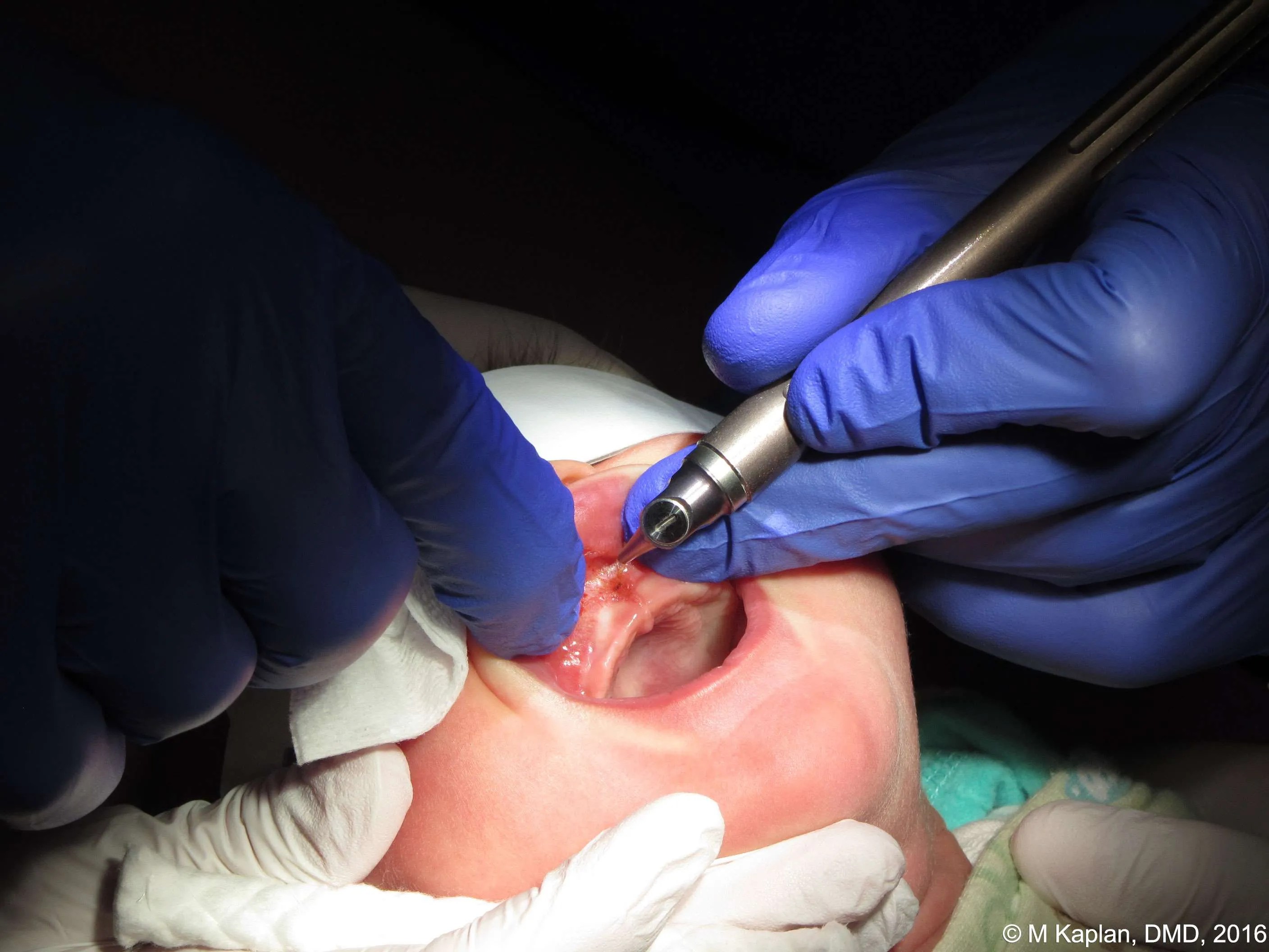 Pediatric Tongue and LipTies Diagnosis and Treatment with Soft