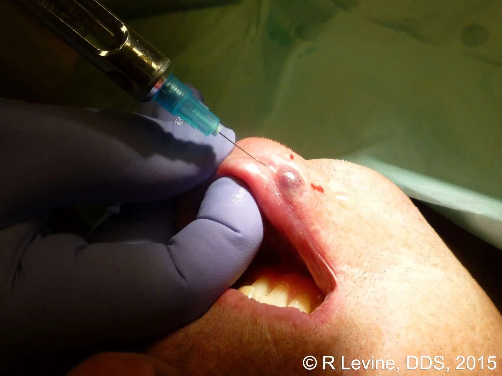 CO2 Laser Ablation of the Capillary Hemangioma of the Lip LightScalpel
