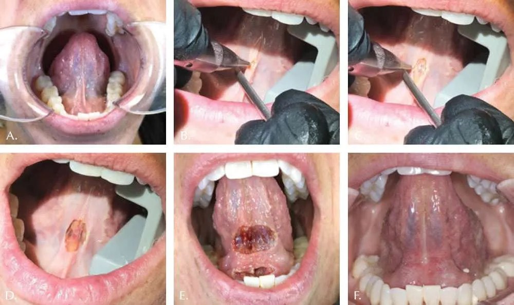 Functional Frenectomy (Osteopathically Guided) Michael Geis, DO