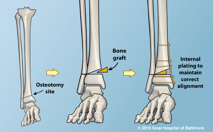 Internal Fixation Plates International Center for Limb Lengthening