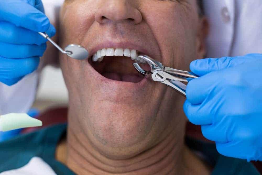 Tooth Extraction in Sri Petaling Loose Tooth & Wisdom Teeth Removal