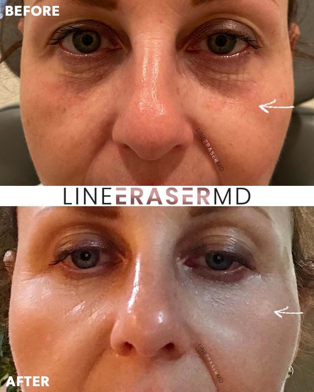 Tear Trough Correction And Treatment NJ Line Eraser MD