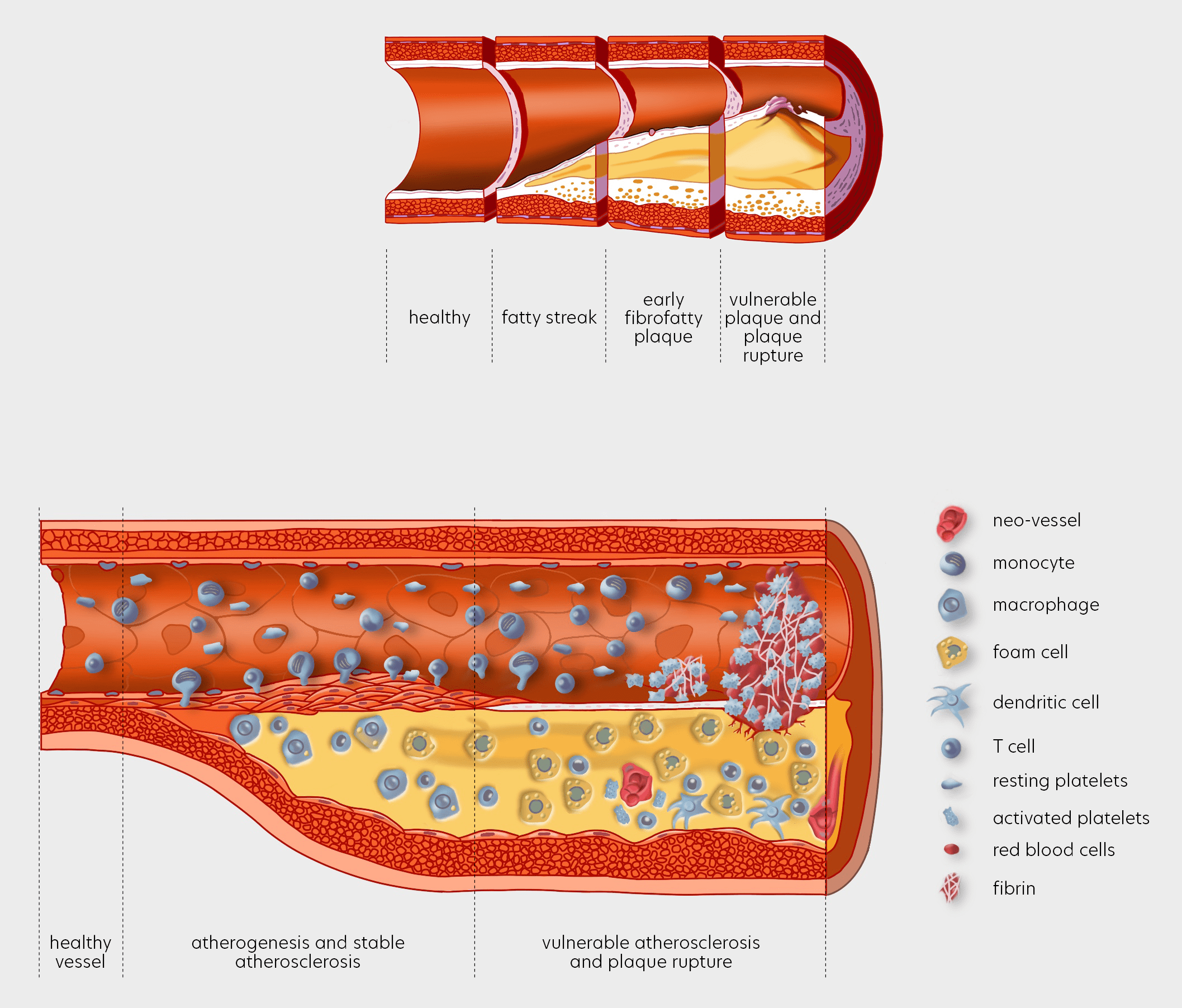 Atherosclerosis and cardiovascular risk Lipid Tools