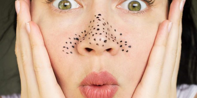 Berbagai Cara Menghilangkan Blackhead Membandel Tanpa Repot