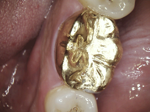 Broken Tooth. Fillings and Crowns. Bytes Dental Lismore