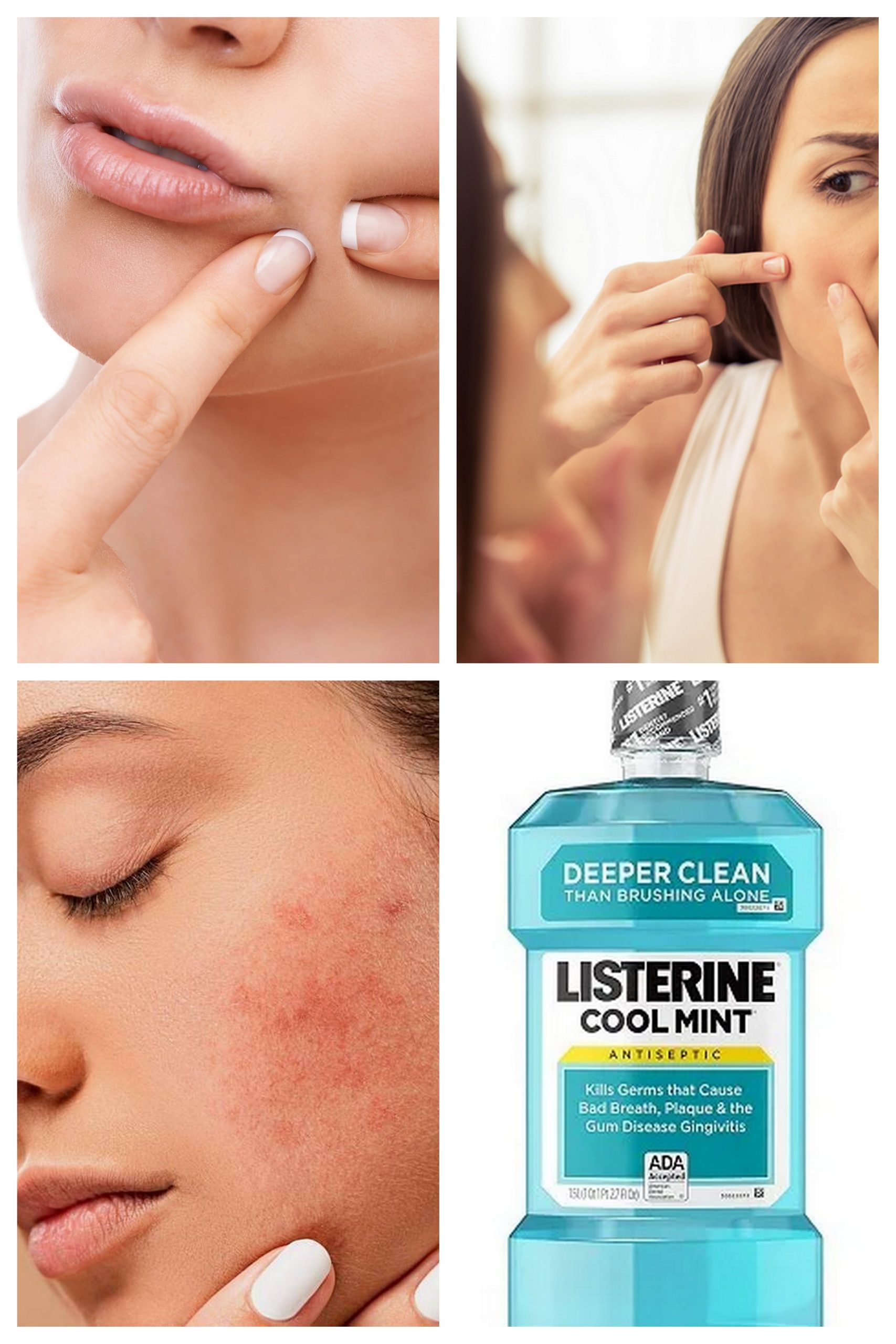 Surprising Listerine Mouthwash Uses For Common Skin Problems