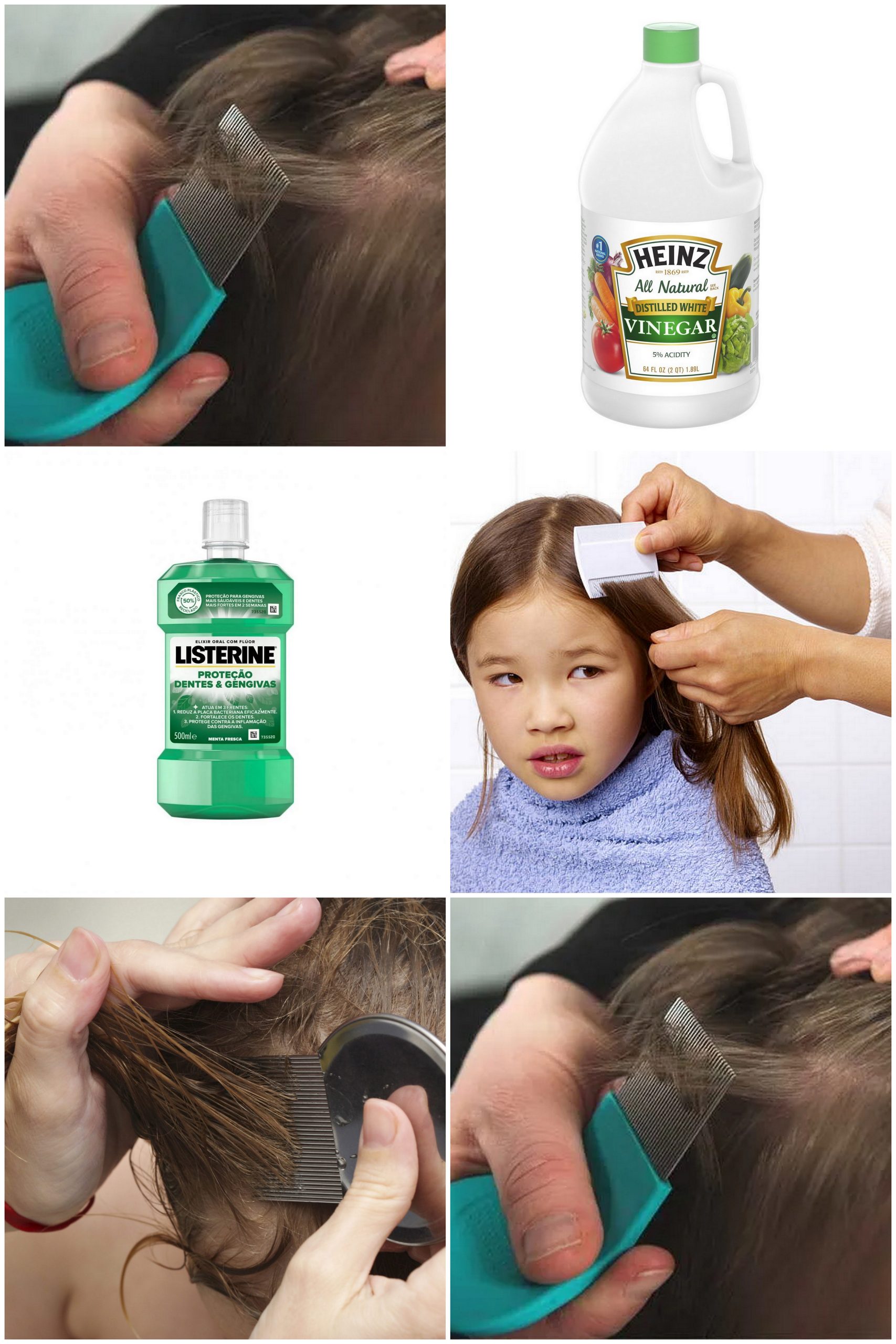 Vinegar And Listerine Head Lice Treatment For 2023 Listerine Foot Soak