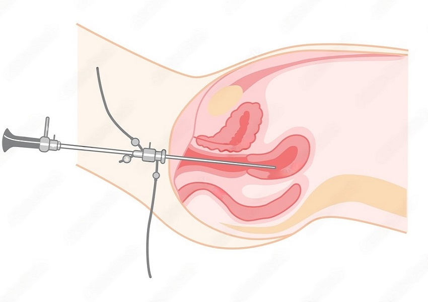 What is the Role of Hysteroscopy in IVF? Dr Mona Dahiya