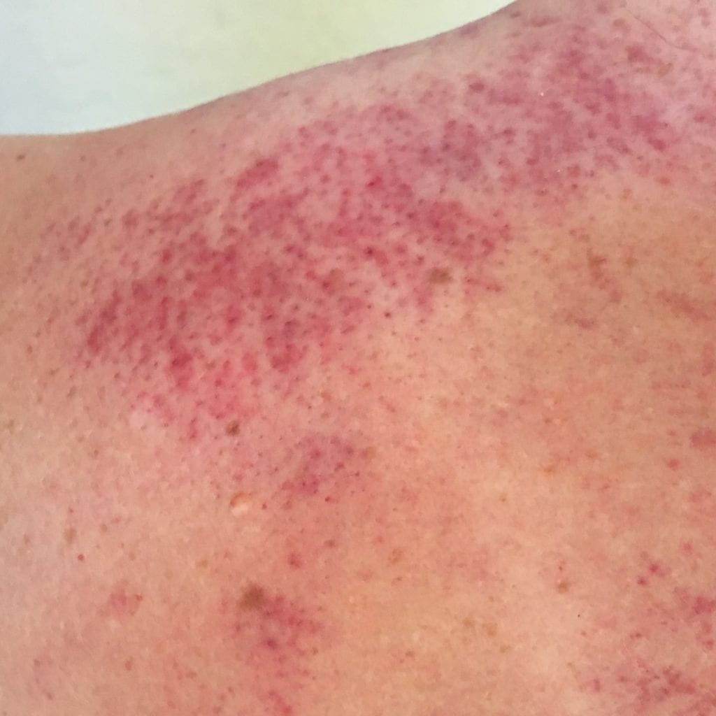 GUA SHA Live Oak Acupuncture