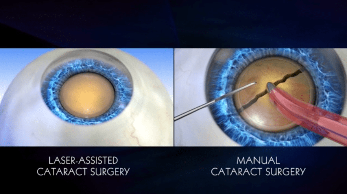 Traditional and Premium Laser Cataract Surgery Which Should You Choose
