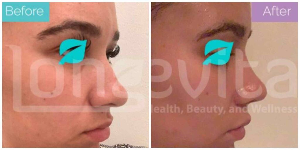 Hit My Nose After Rhinoplasty Are The Results Ruined? Longevita