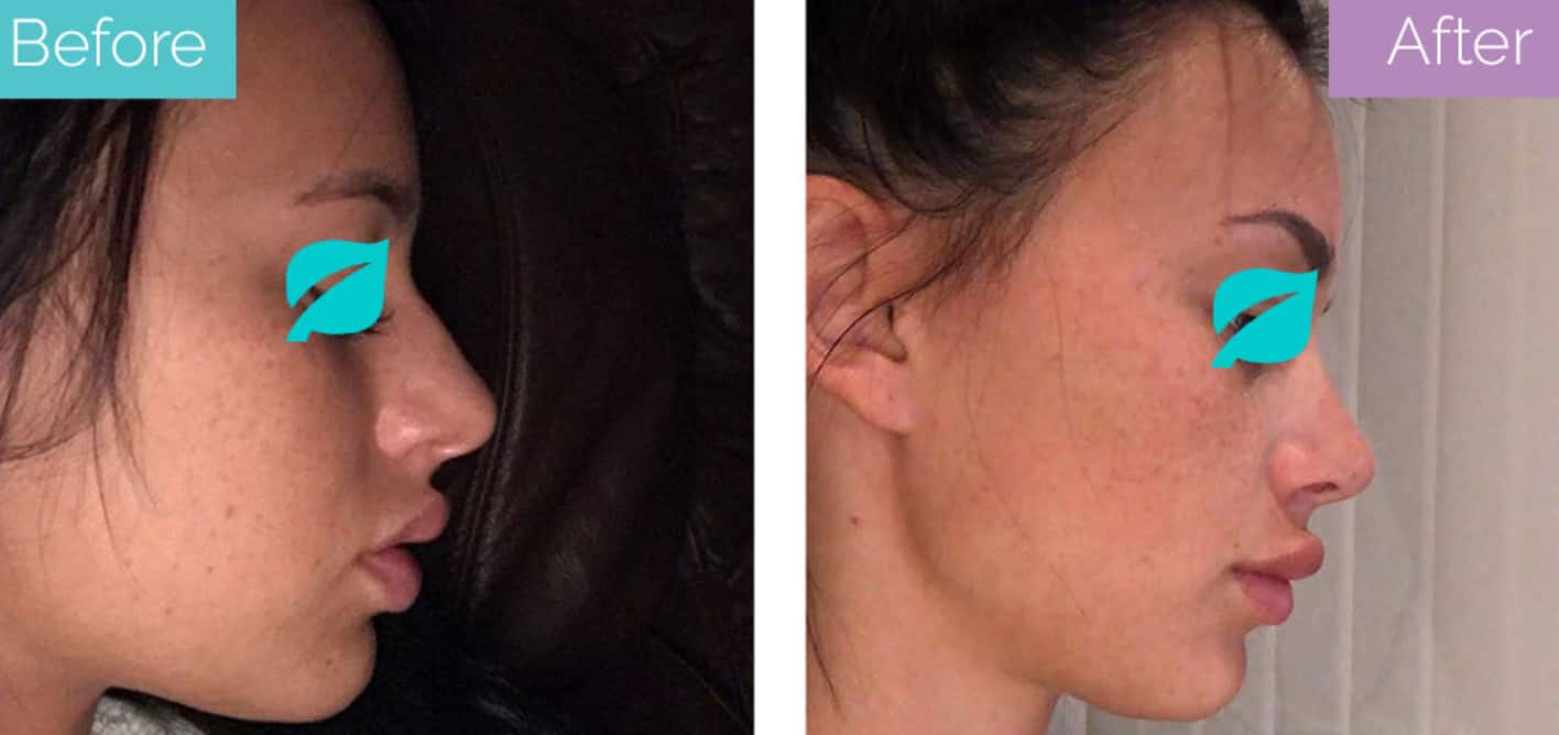 How To Get A Free Nose Job In The UK? Longevita