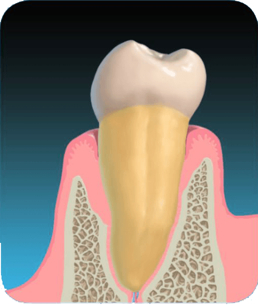 Perioscopy Treatment Periodontists in Long Island, NY