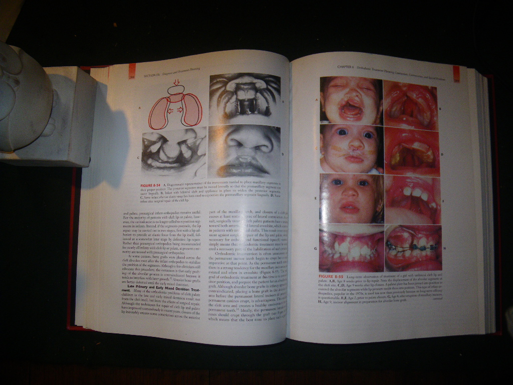 Contemporary Orthodontics by William R. Proffit. Mosby Inc, 2000 The