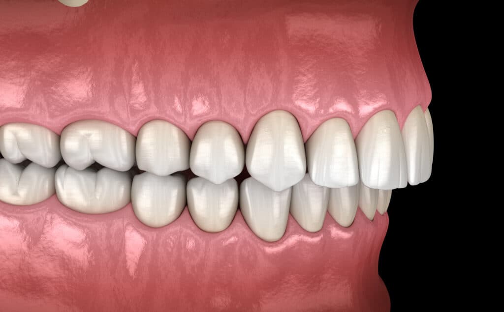 How Does My Bite Classification Impact Orthodontic Treatment
