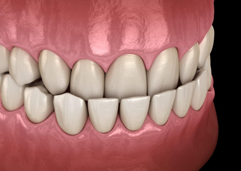 How Does My Bite Classification Impact Orthodontic Treatment