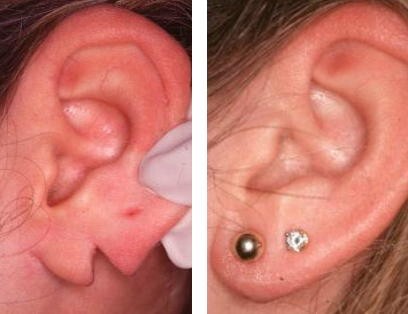 Repair of Torn Earlobes