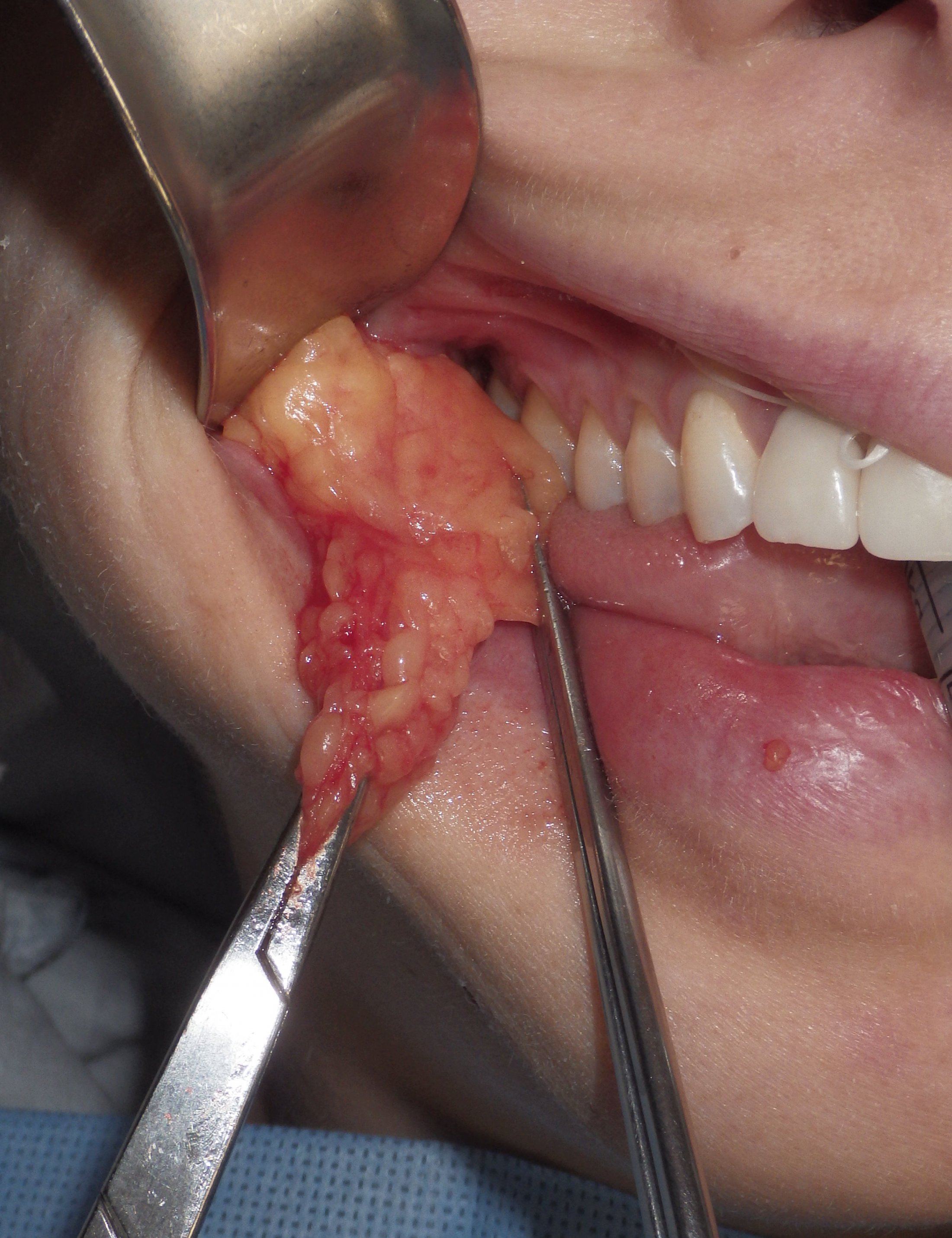 Buccal Fat Pad Reduction Richmond VA Midface Procedure